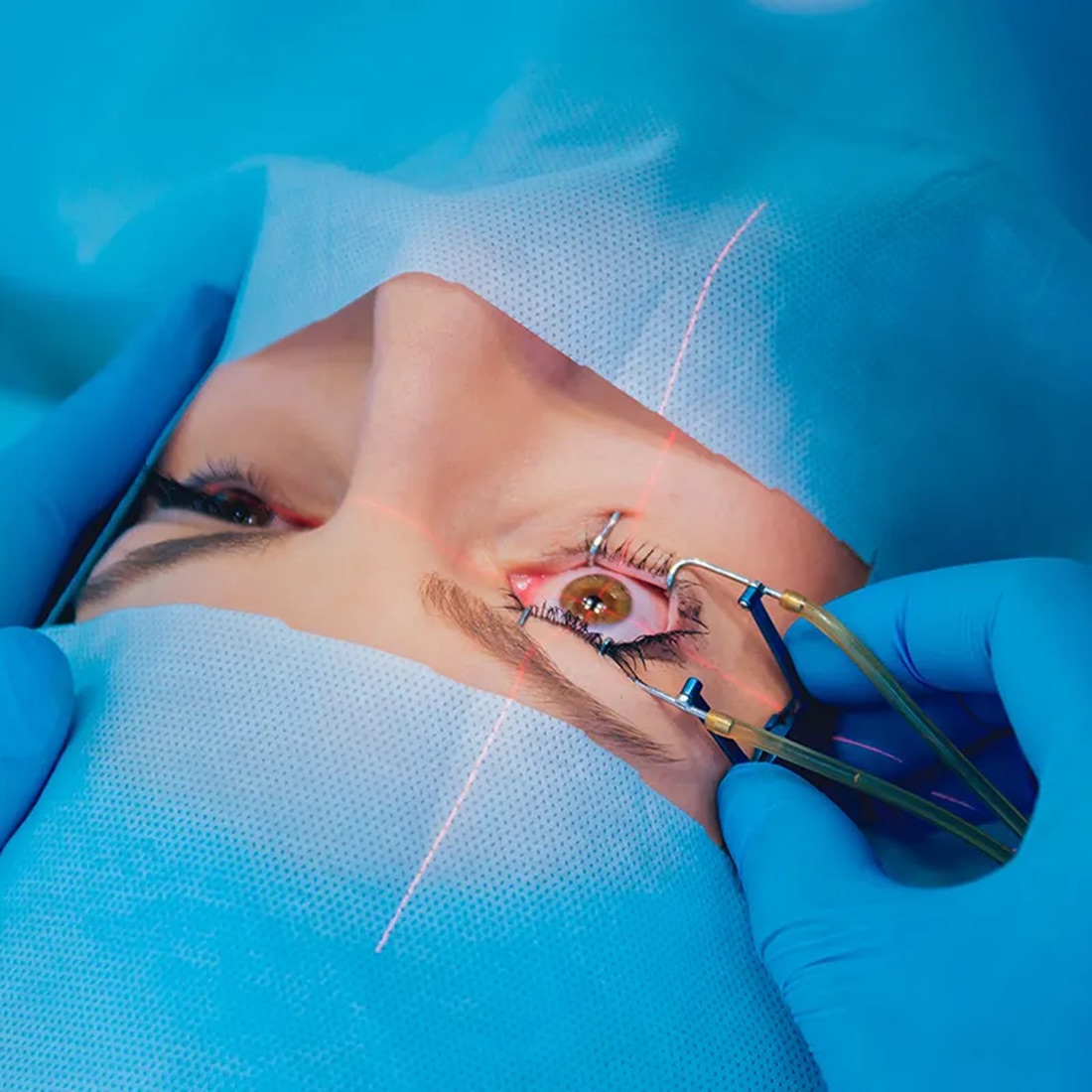 Cirurgia refrativa